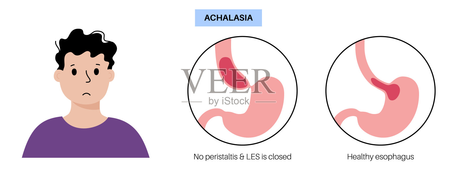 食道失弛缓症插画图片素材