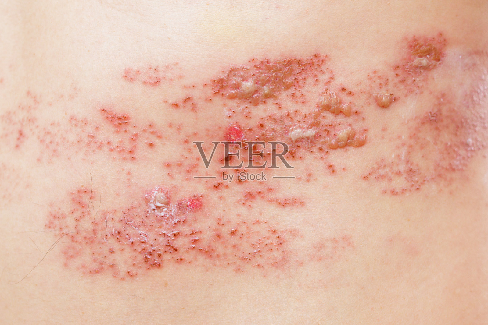 男人得了带状疱疹照片摄影图片