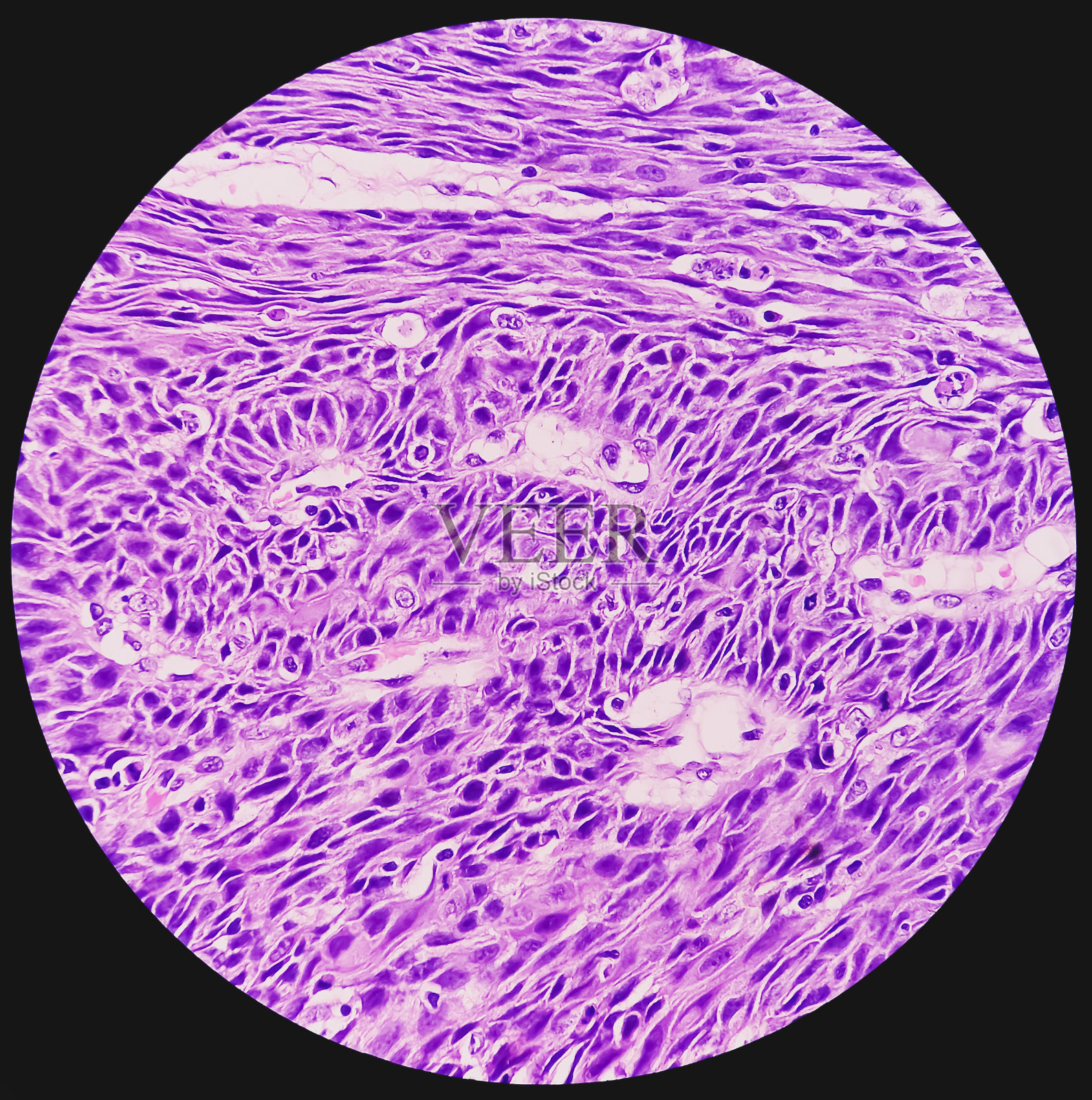 直肠癌显微照片。炎症性肠病。肠易激综合症。直肠鳞状细胞癌。2级直肠癌，镜下。照片摄影图片