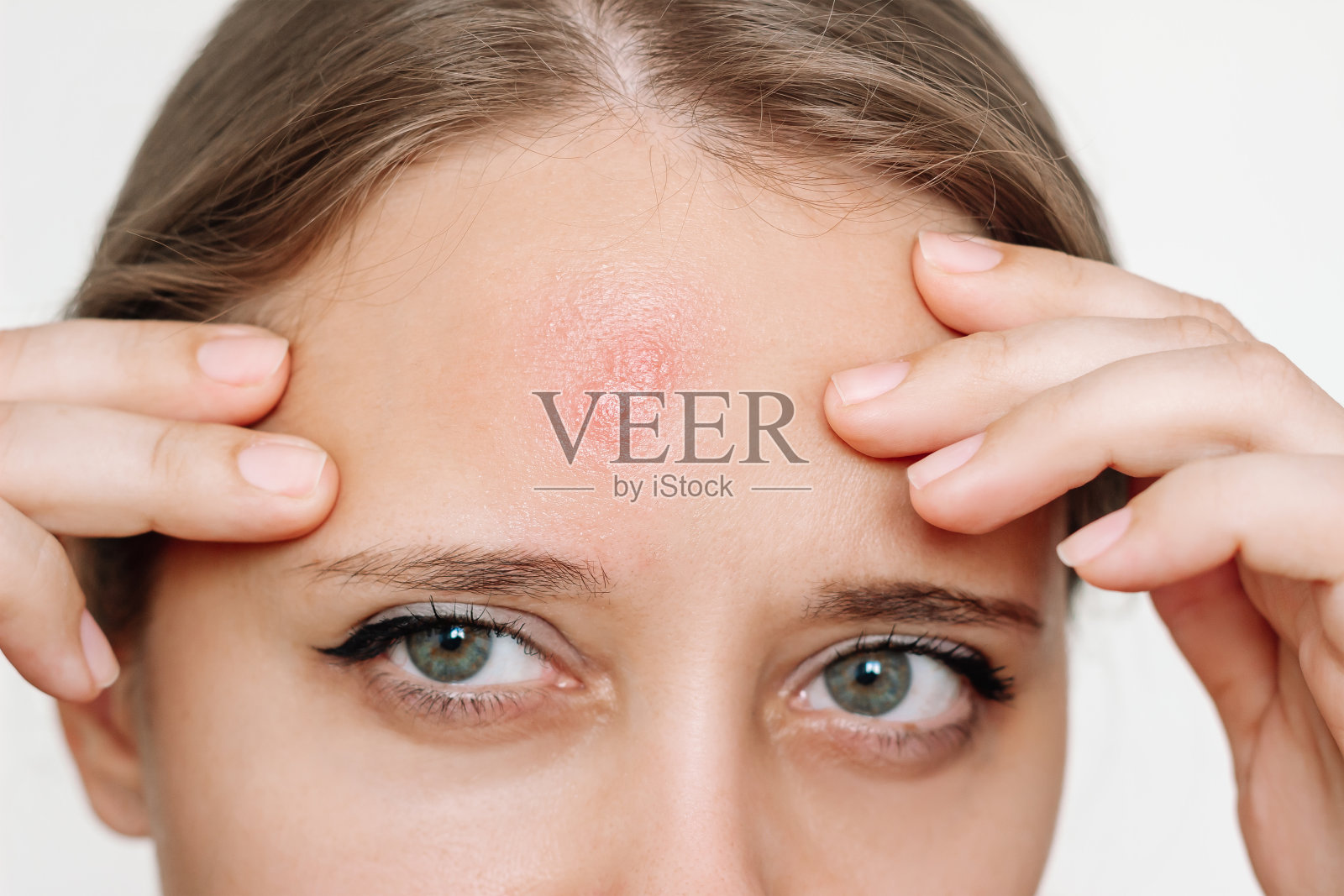 年轻女性面对粉刺的问题。额头上有红疹。过敏，皮炎，粉刺照片摄影图片