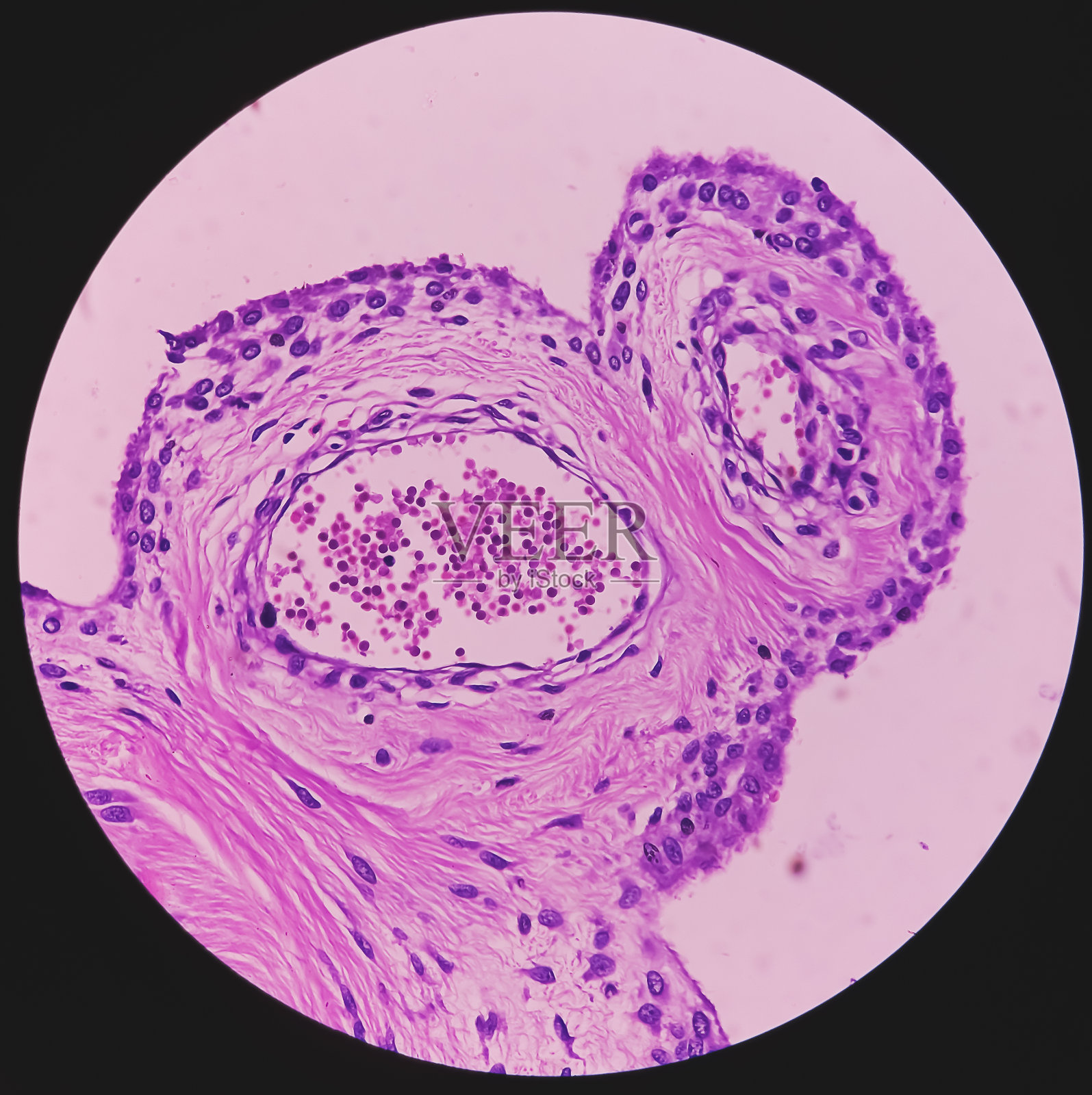 滑膜组织(活检):绒毛结节性滑膜炎。神经节细胞，涂片显示滑膜覆盖的乳头状、绒毛状和结节状区域。病灶显示滑膜衬里的裂隙状间隙。照片摄影图片