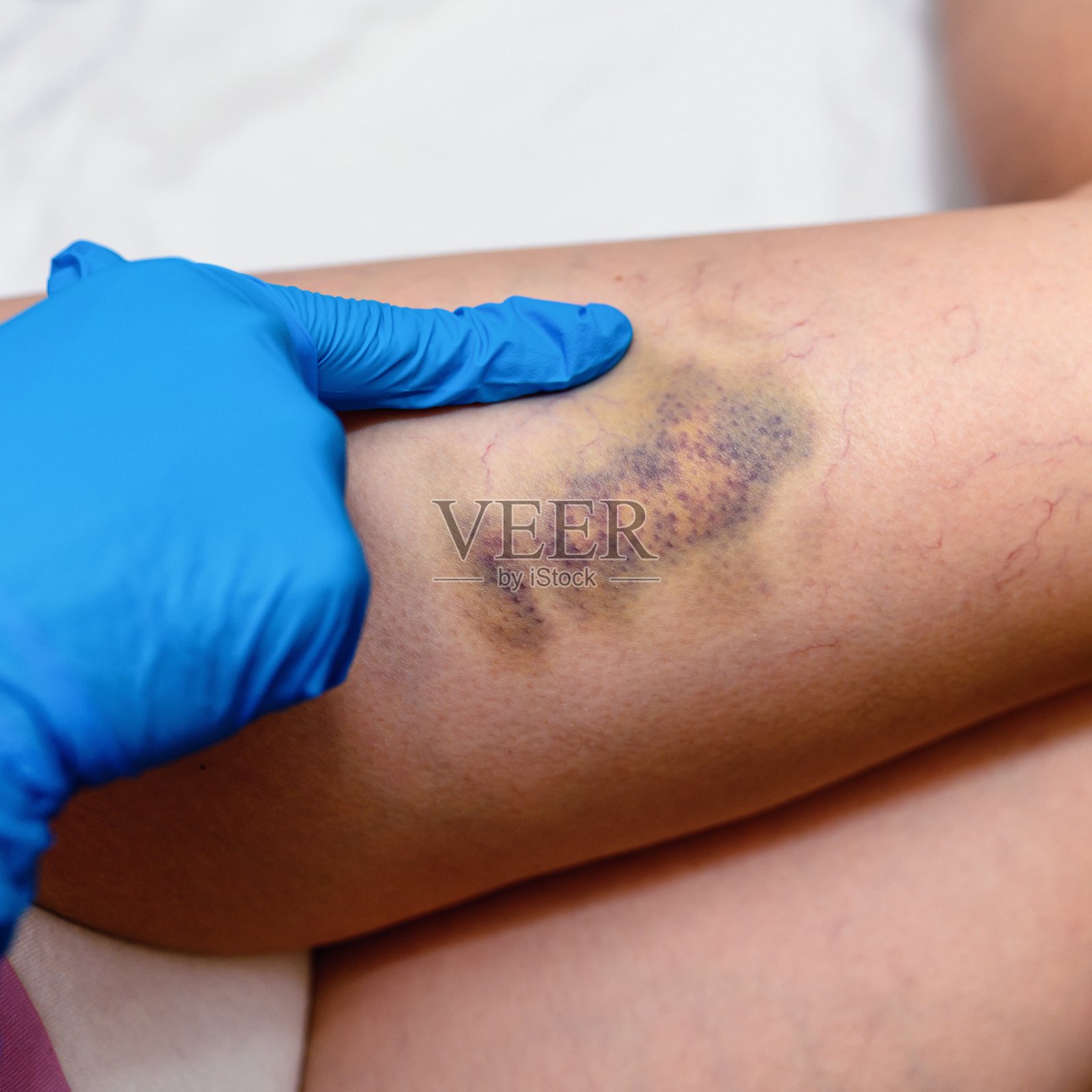 腿部瘀伤照片摄影图片