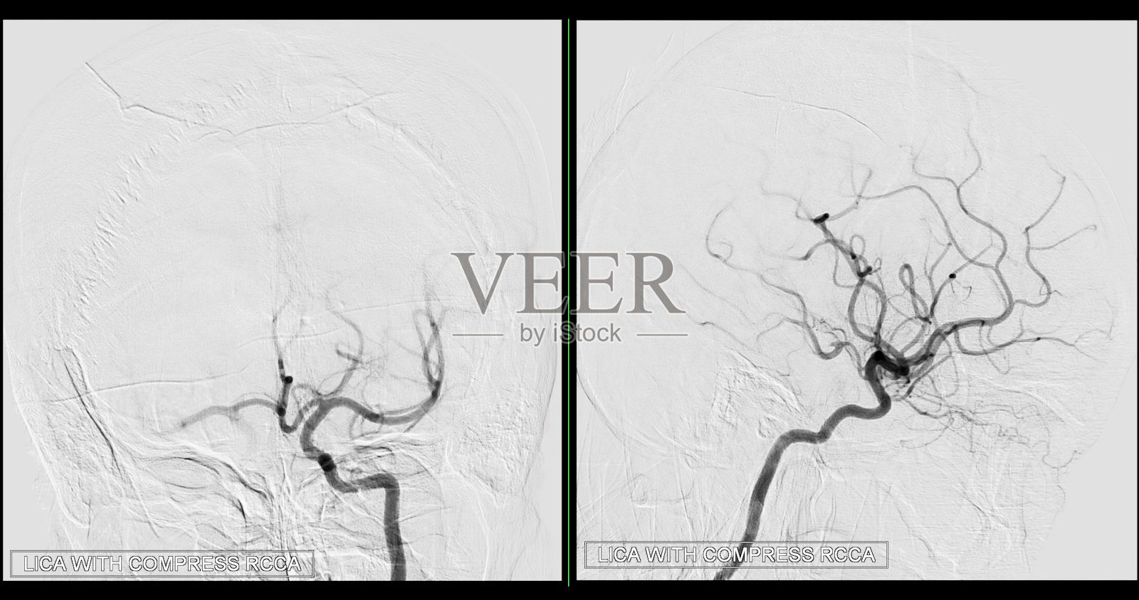 介入放射学中透视的脑血管造影图像显示大脑动脉。照片摄影图片