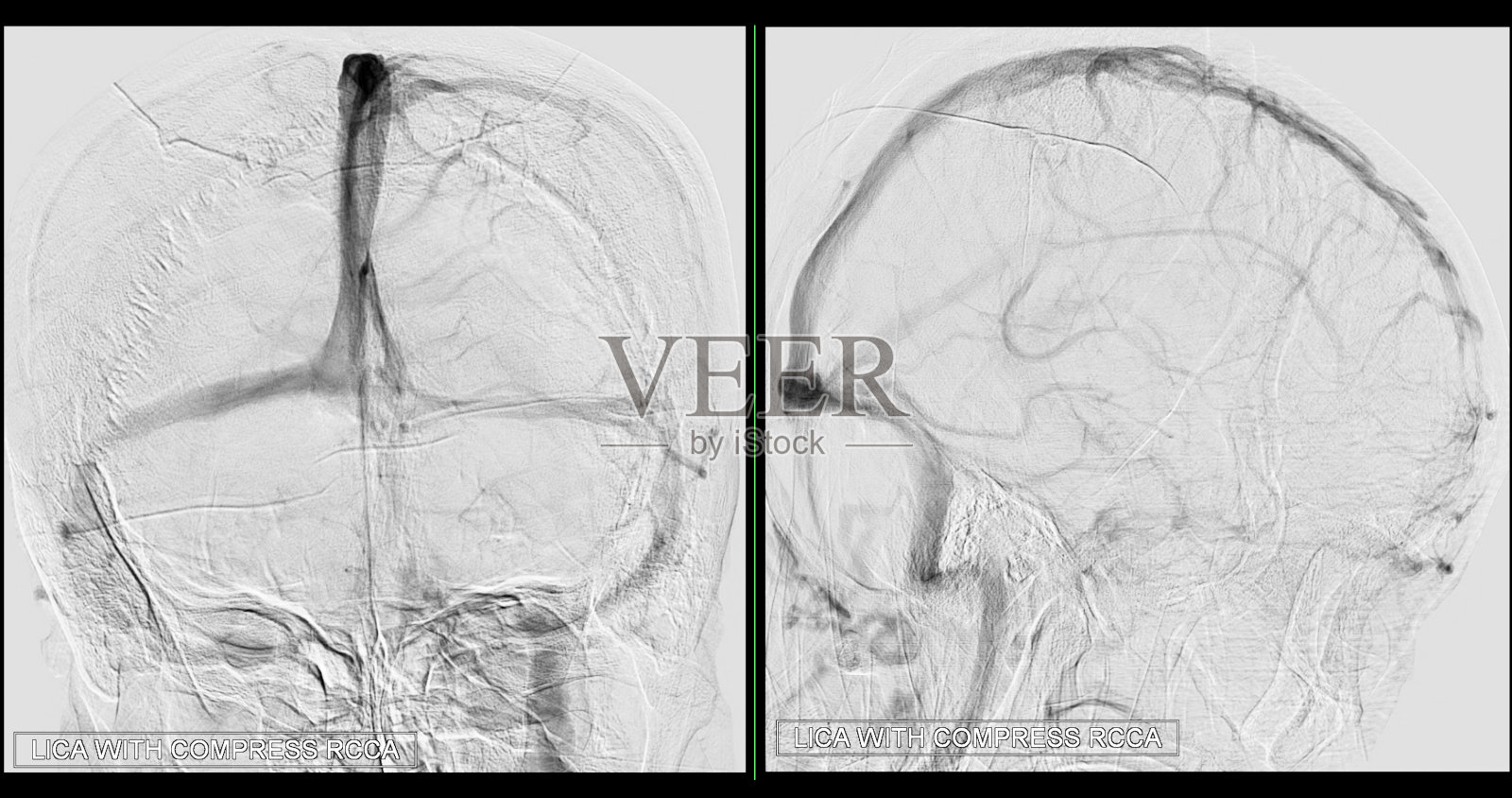 介入放射学中透视的脑血管造影图像显示大脑动脉。照片摄影图片