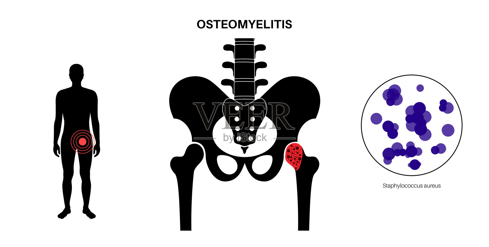 髋关节骨髓炎插画图片素材