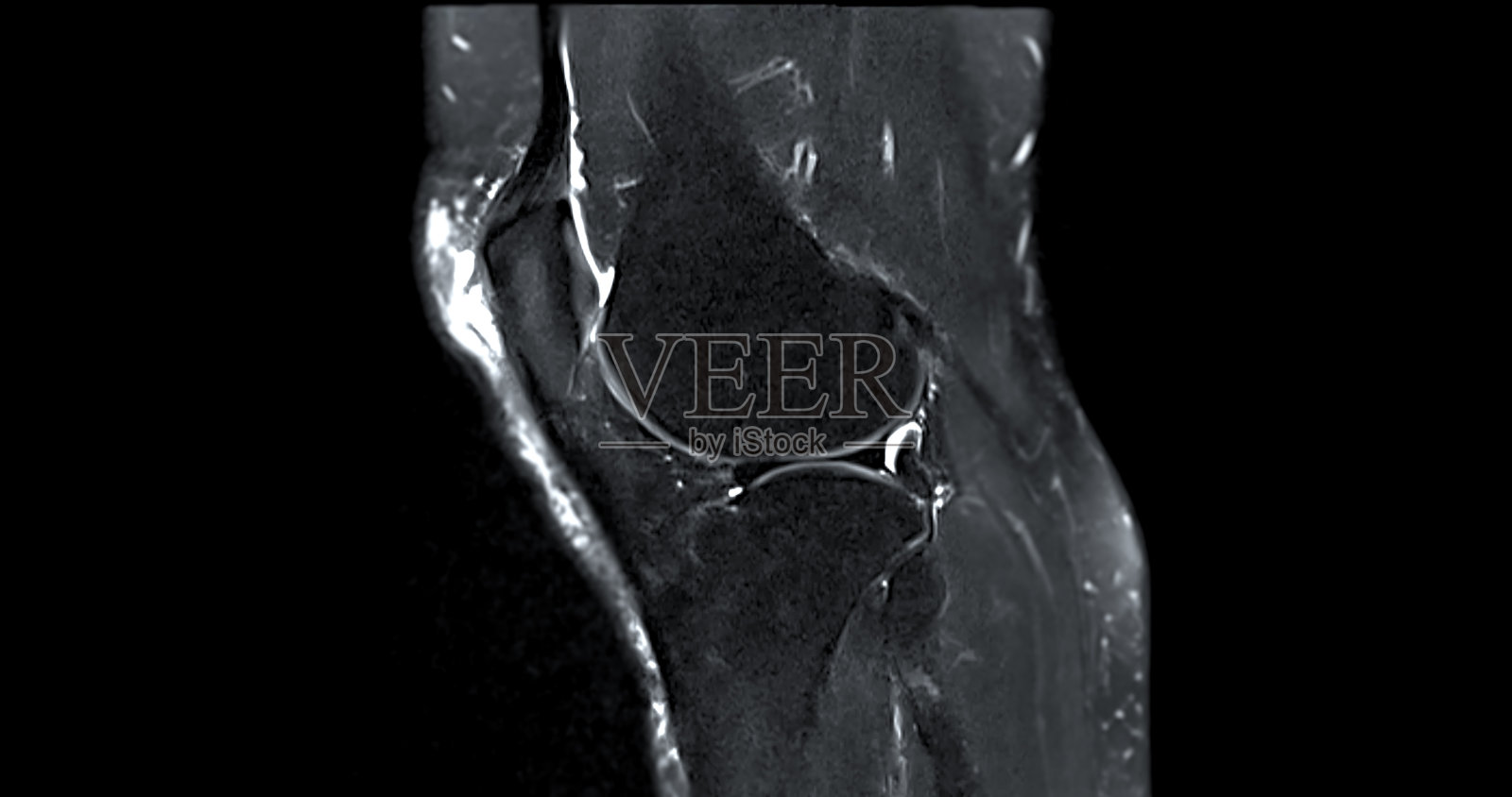 膝关节c的磁共振成像或MRI检查前交叉韧带撕裂或扭伤照片摄影图片