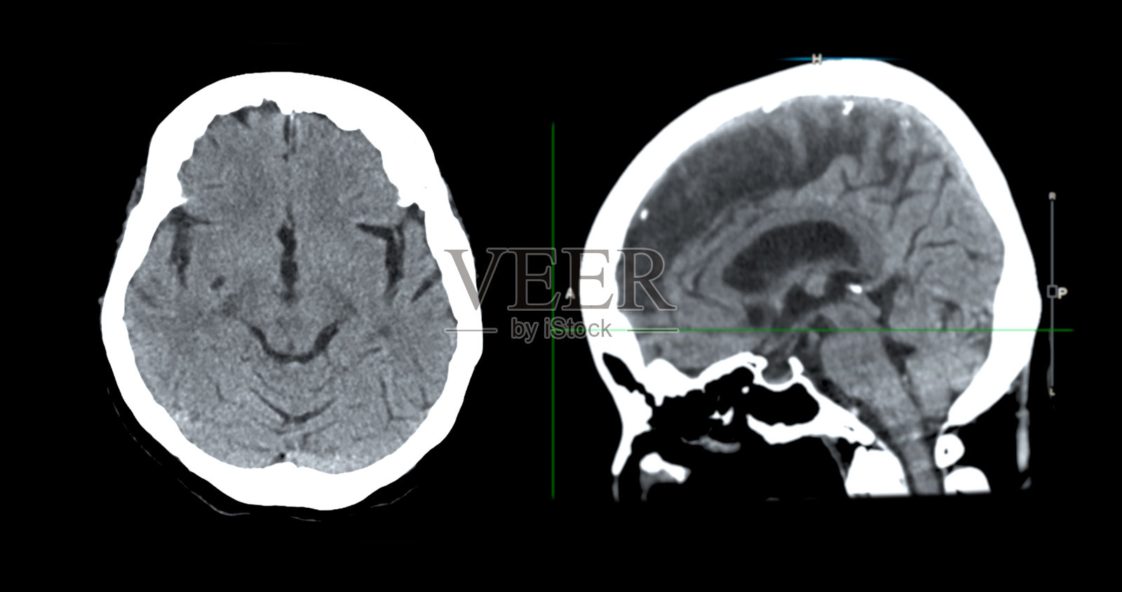 CT扫描脑矢状面对脑肿瘤、脑卒中及血管性疾病的诊断价值。照片摄影图片