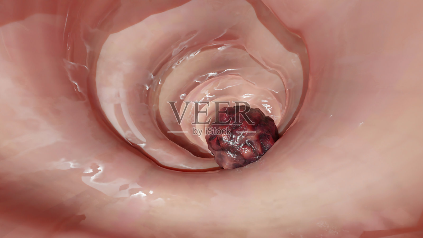 肠癌或结直肠癌、结肠癌、肠炎性疾病、肠痛、乳糜泻、感染、复制、细胞扩张、恶性癌、病毒、3d渲染照片摄影图片