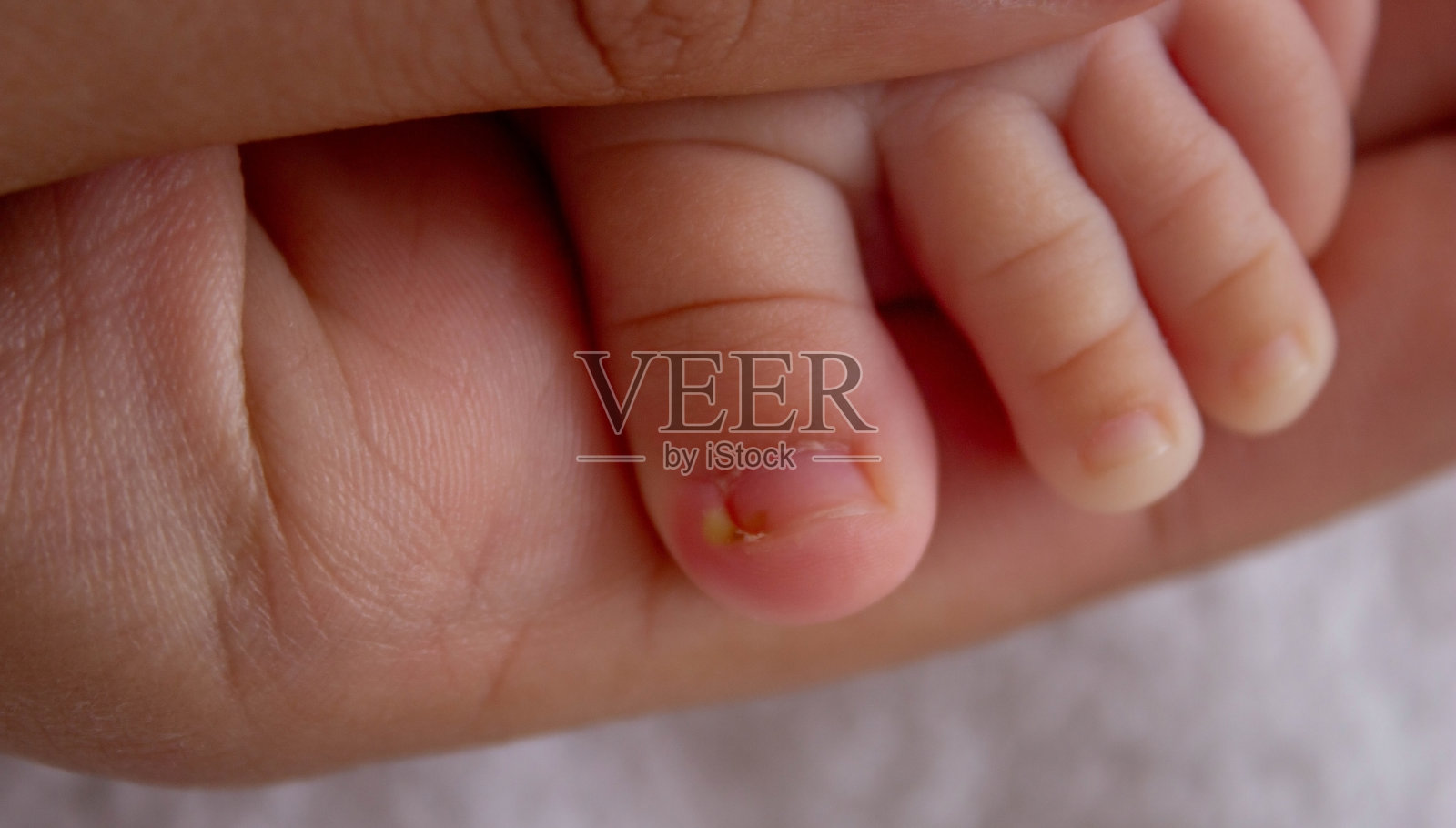 婴儿，脓液，指甲长成了手指。照片摄影图片