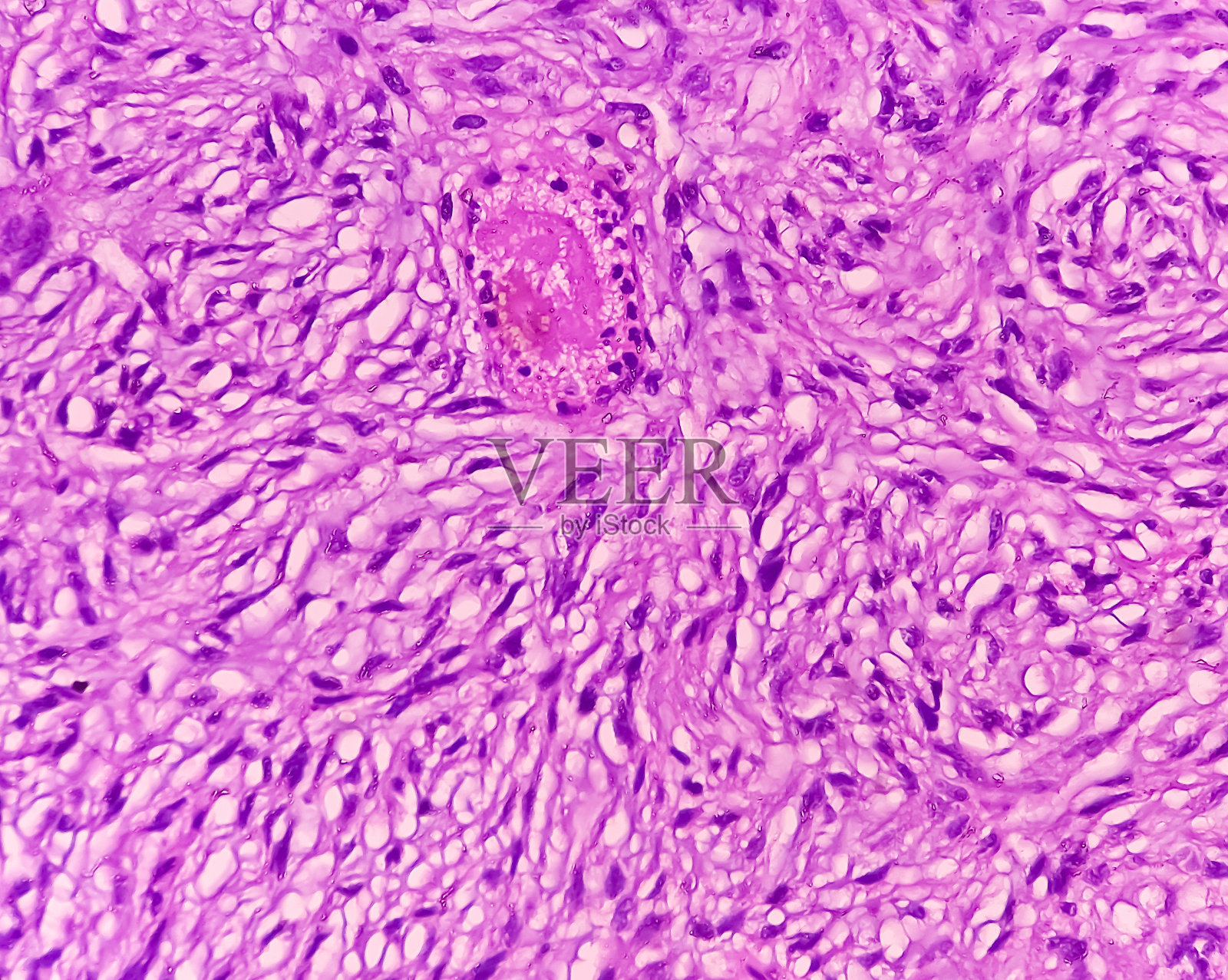 嗅沟肿瘤(活检):脑癌，脑膜瘤，示成纤维性脑膜瘤。恶性肿瘤。照片摄影图片