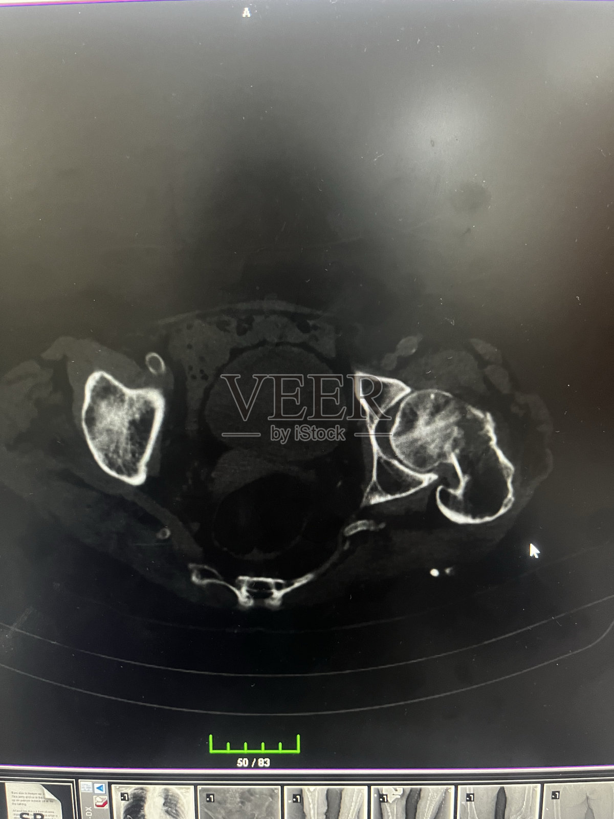 一位82岁女性患者在家中跌倒后的计算机断层扫描显示左侧股骨颈骨折。2023年，土耳其科尼亚。照片摄影图片