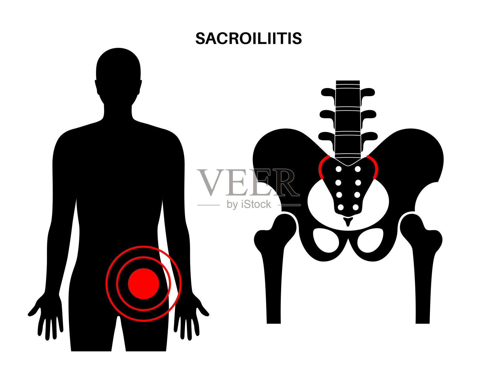 骶髂炎的医疗海报插画图片素材
