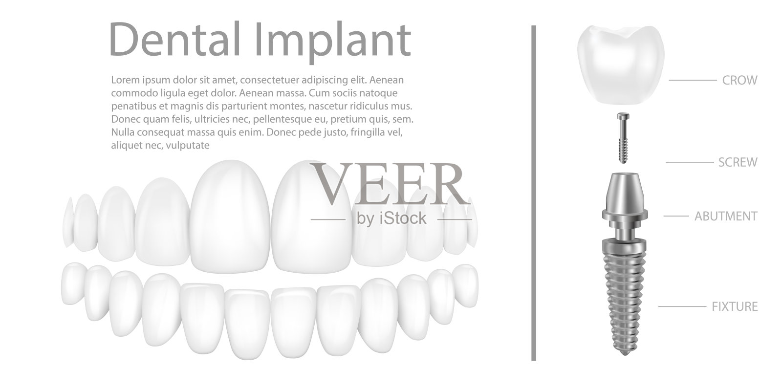 牙种植体结构医学图片教育信息图海报与磨牙替代末端健康工具模型矢量插图。插画图片素材