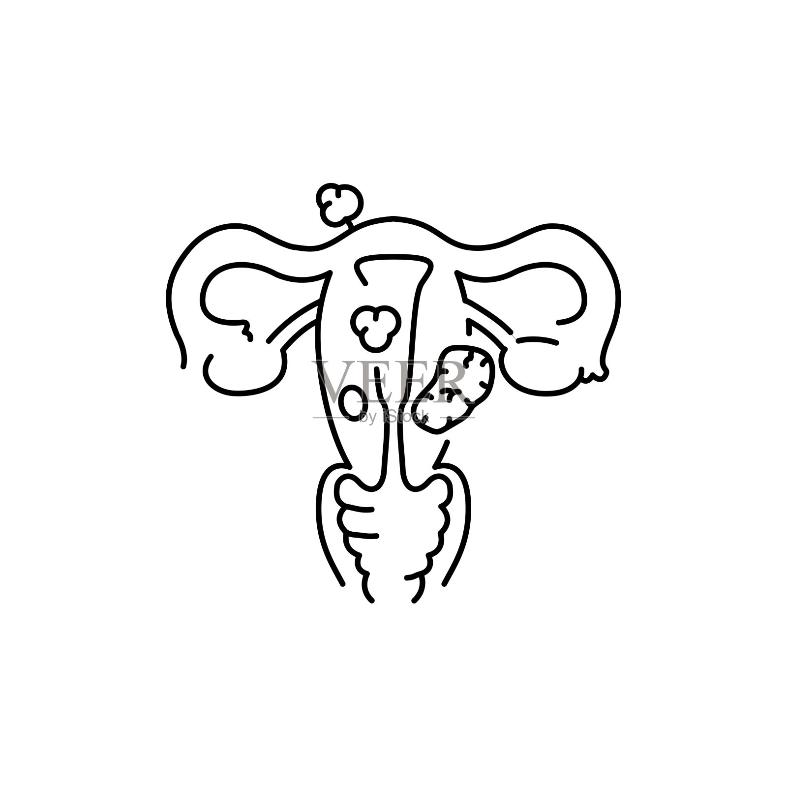 子宫肌瘤色线图示。妇科问题插画图片素材