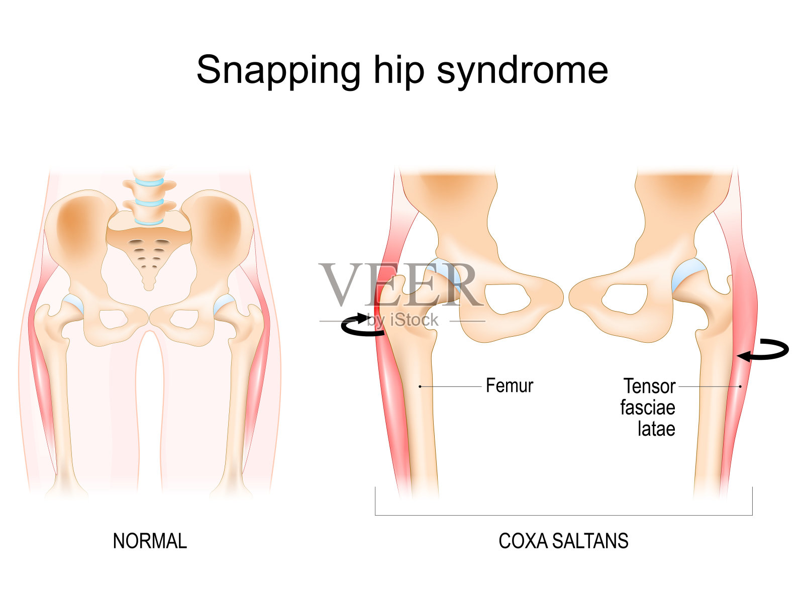 髋裂综合征。髋saltans。插画图片素材