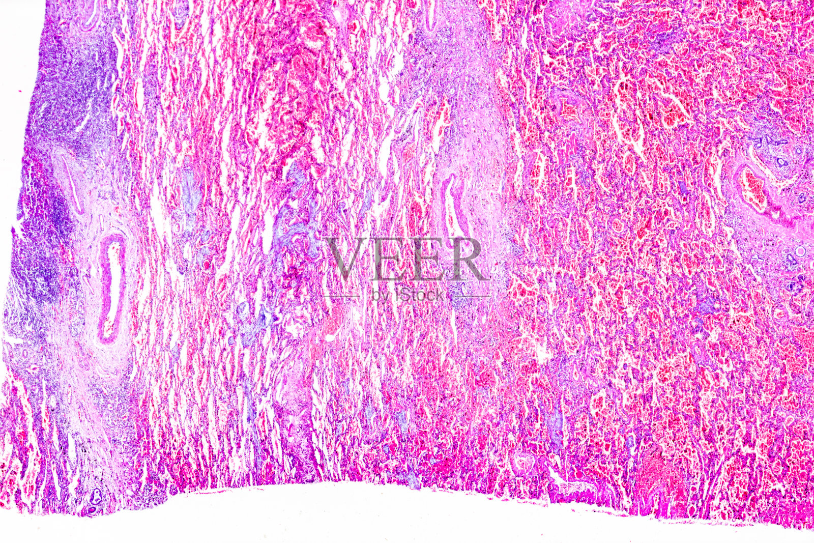 人间质性肺炎不同部位的显微病理标本照片摄影图片