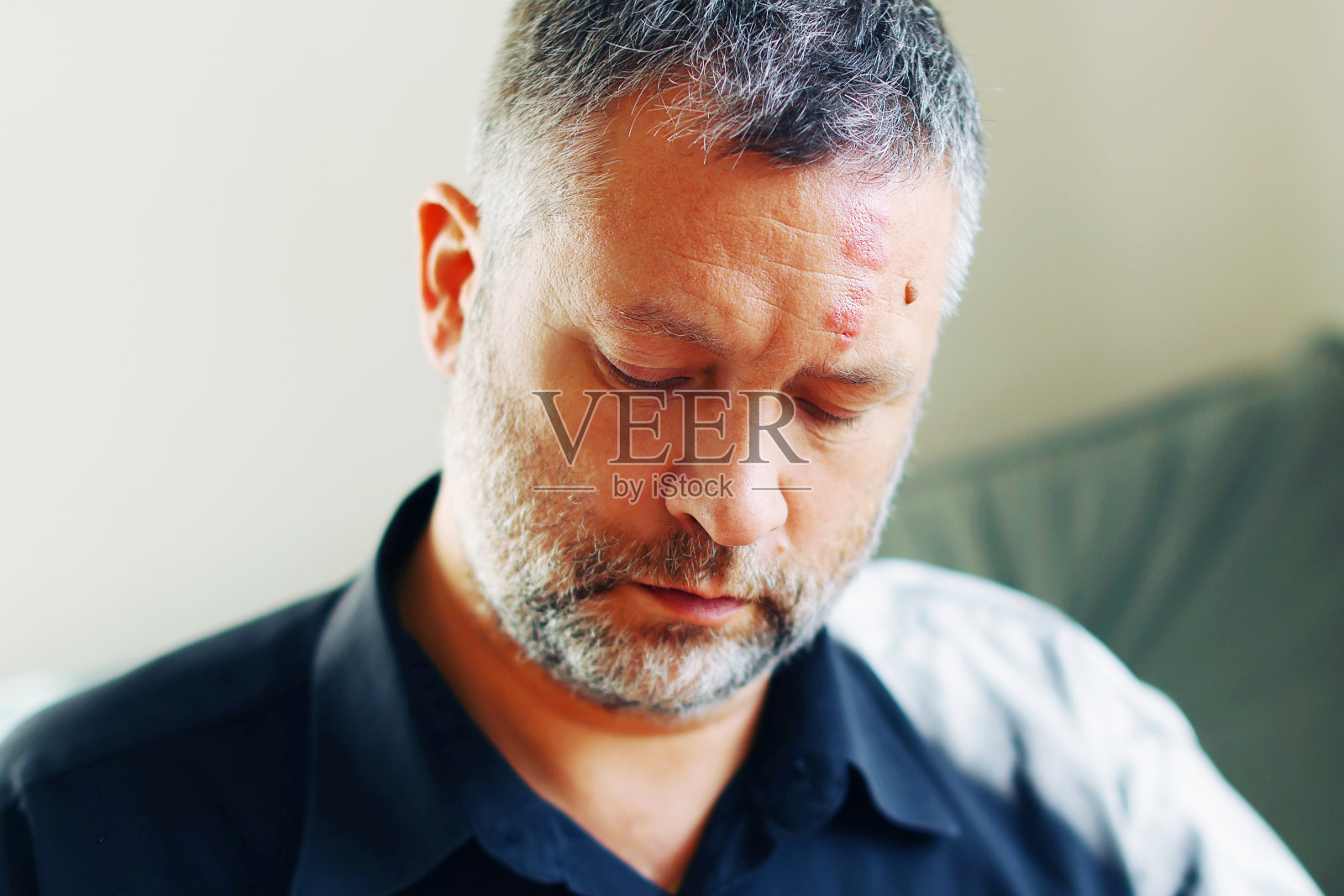 男子带状疱疹(带状疱疹)在脸上，近距离。一个男人脸上长了疱疹。照片摄影图片