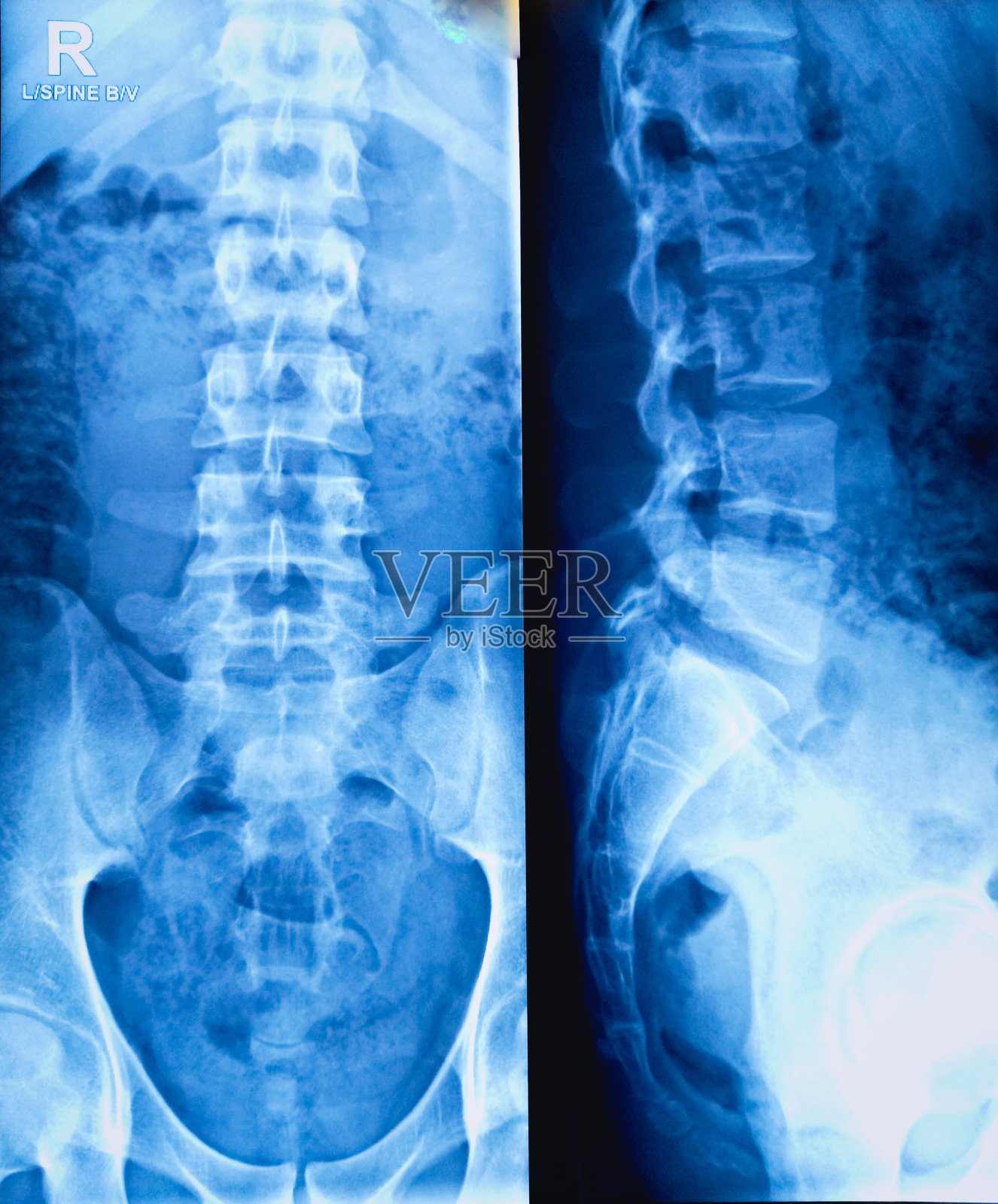 骶骨x线片。照片摄影图片