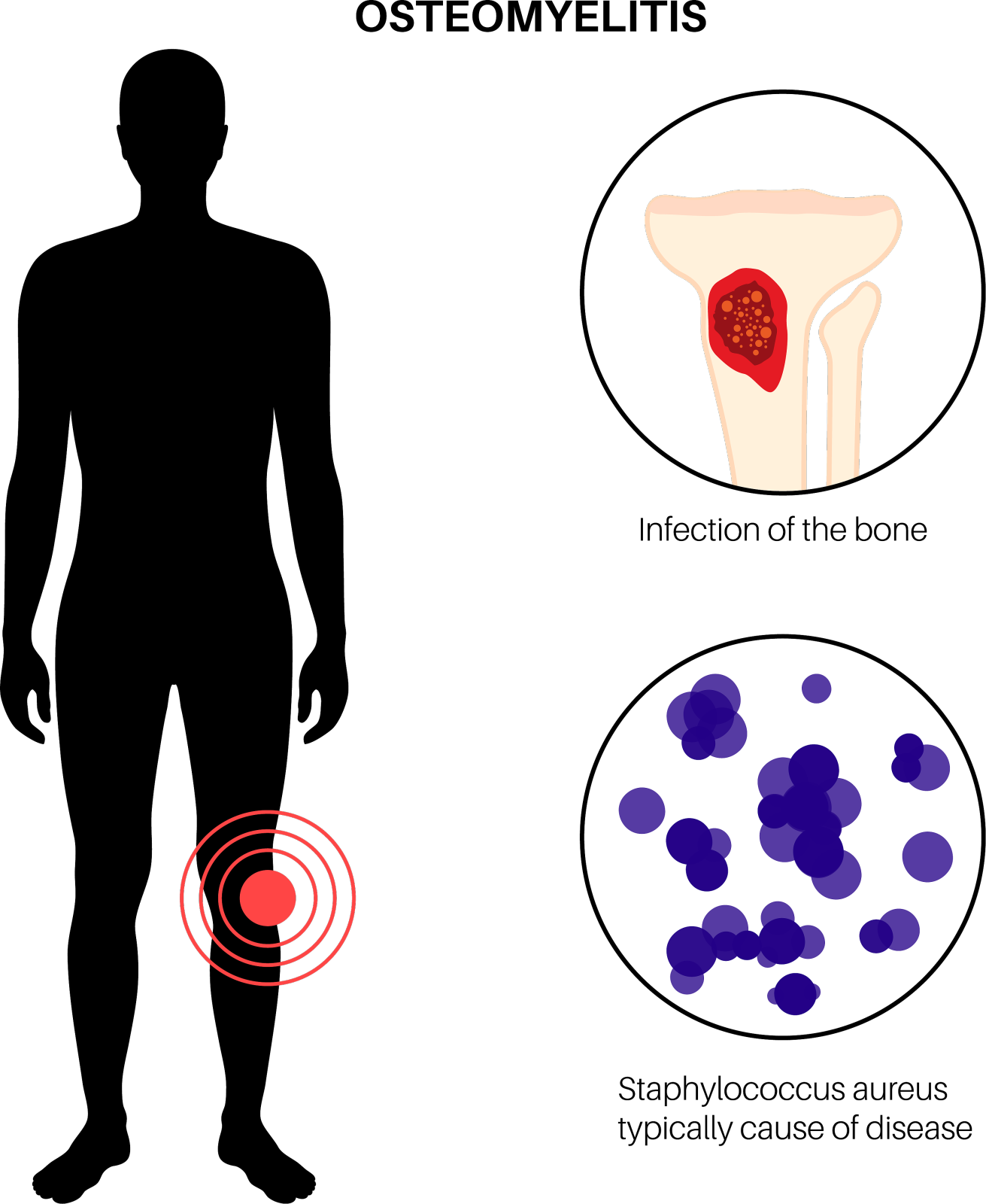 胫骨骨髓炎设计元素图片