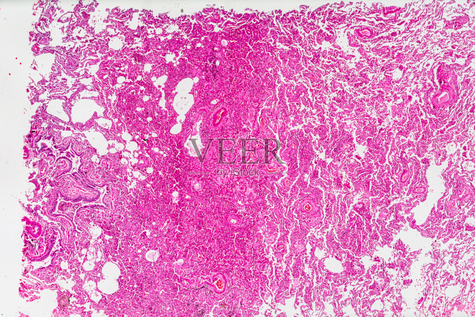 慢性肺充血，光镜下不同区域放大照片摄影图片