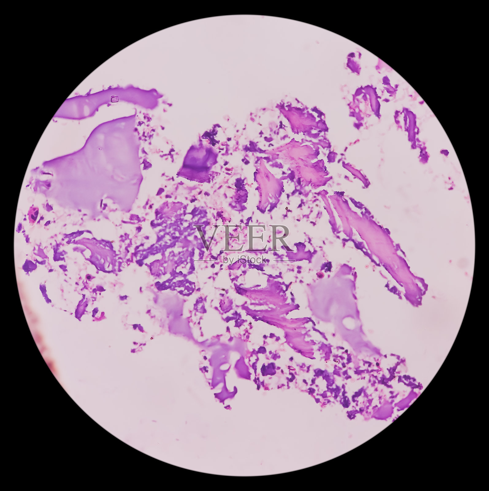 股骨远端(活检):外生。切片显示成熟的透明软骨，上覆纤维软骨膜。照片摄影图片