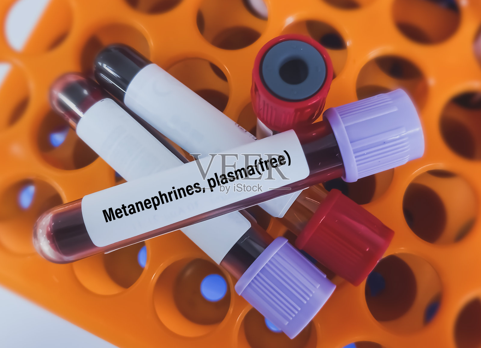 血浆肾上腺素检测对肾上腺髓质分泌儿茶酚胺肿瘤的诊断价值。照片摄影图片
