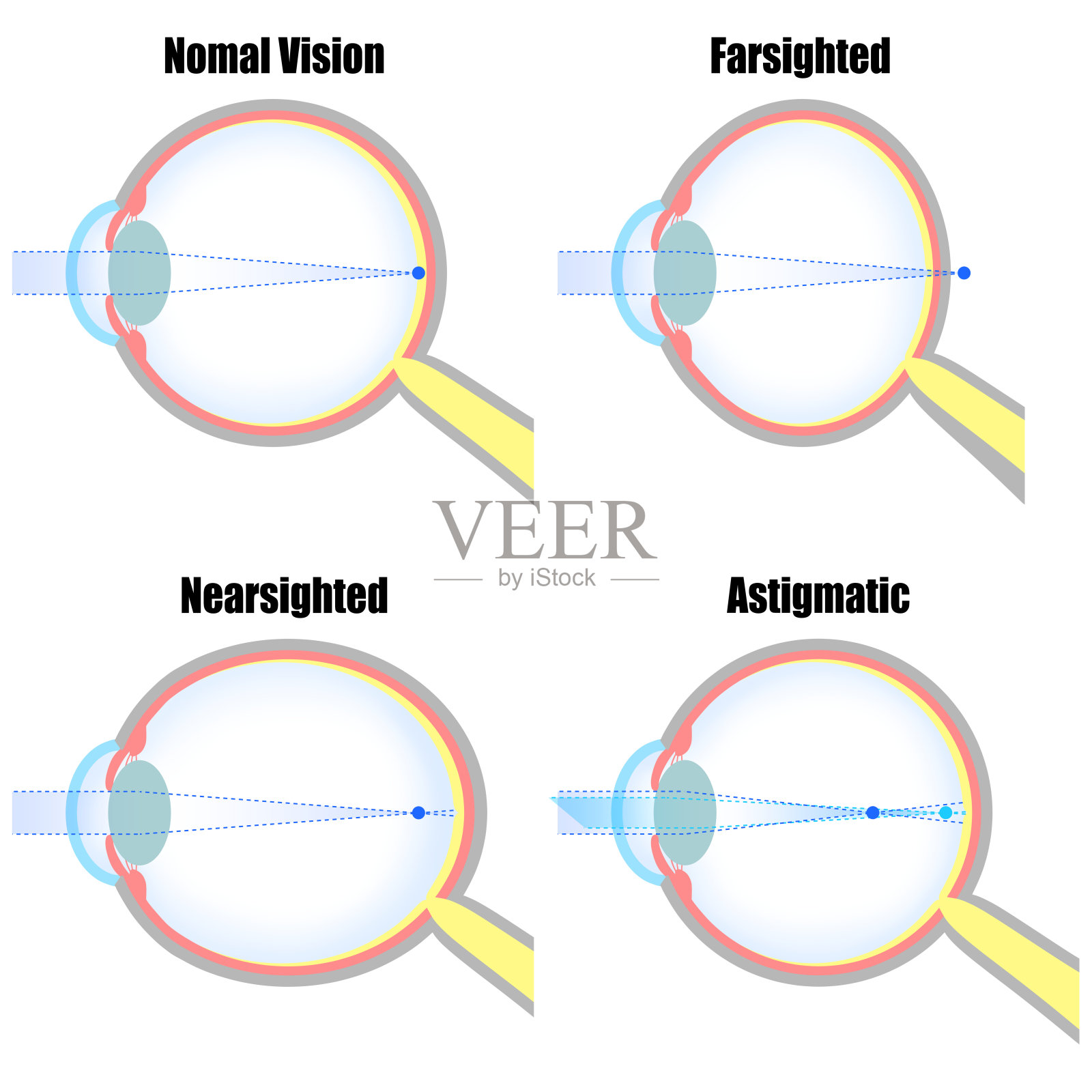 图示名义视力、近视、远视和散光眼球插画图片素材