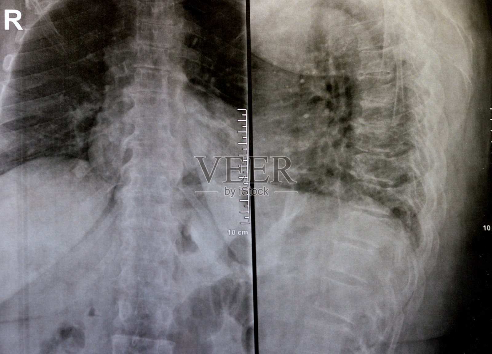 脊椎X光片显示脊椎病变照片摄影图片