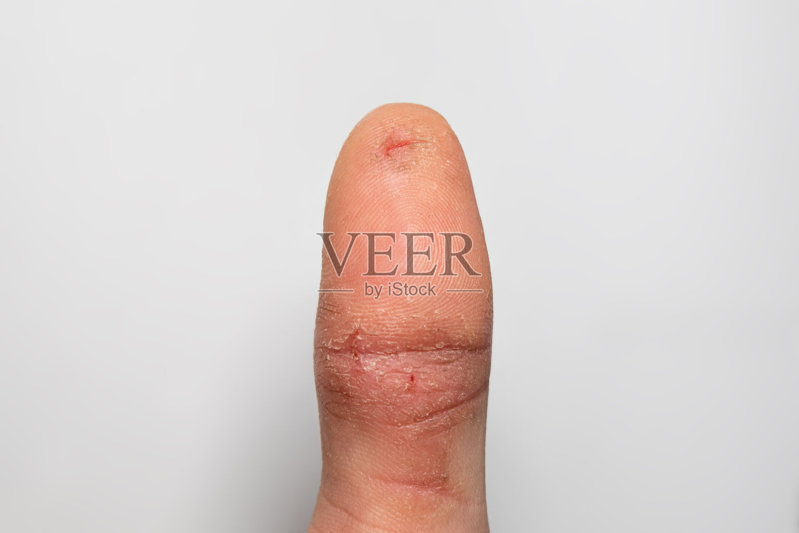 受损的手指皮肤开裂和脱落。一个男人手指上的伤口是由于皮肤问题造成的照片摄影图片