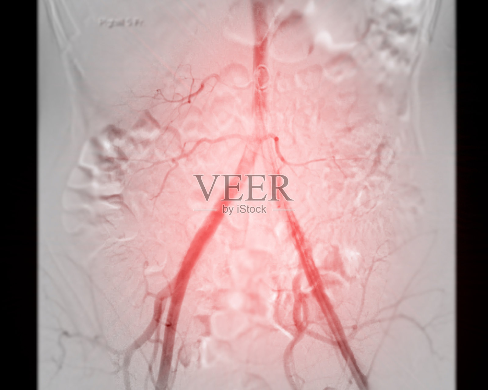 股血管造影是一种用于观察腹股沟区域血管的医疗程序。照片摄影图片