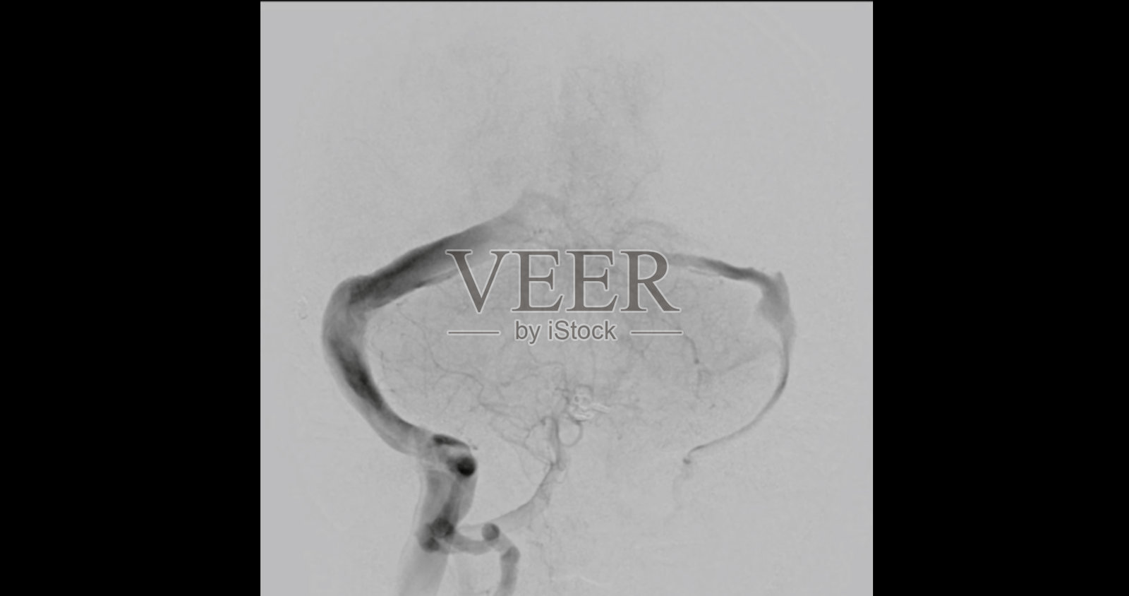 脑血管造影是一种医学成像程序，用于检查大脑中的血管。这一过程有助于诊断动脉瘤、中风或血管异常等疾病。照片摄影图片