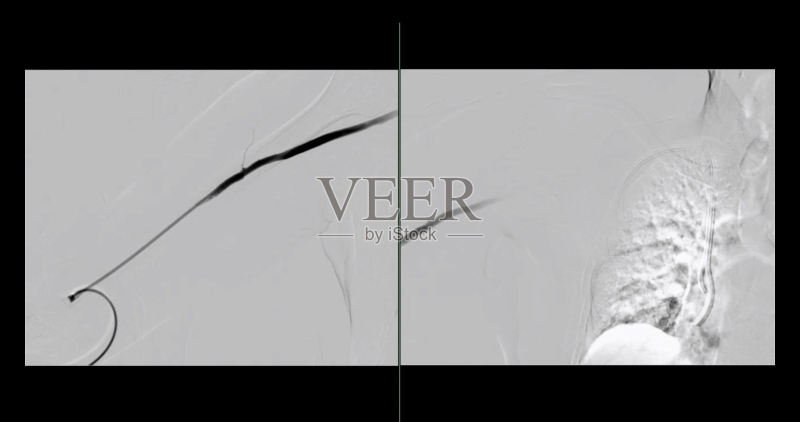 球囊血管成形术是一种用于扩大狭窄或堵塞的血管的医疗程序。照片摄影图片