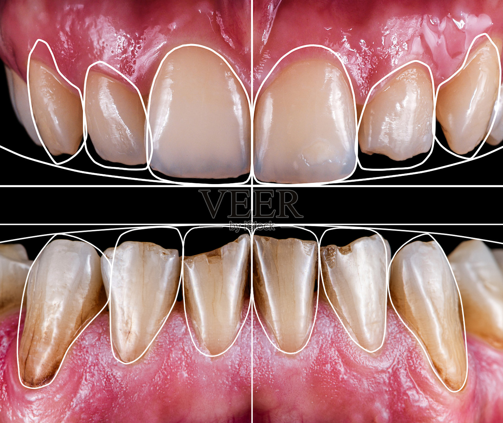 在开始牙科治疗前进行牙齿数字建模照片摄影图片