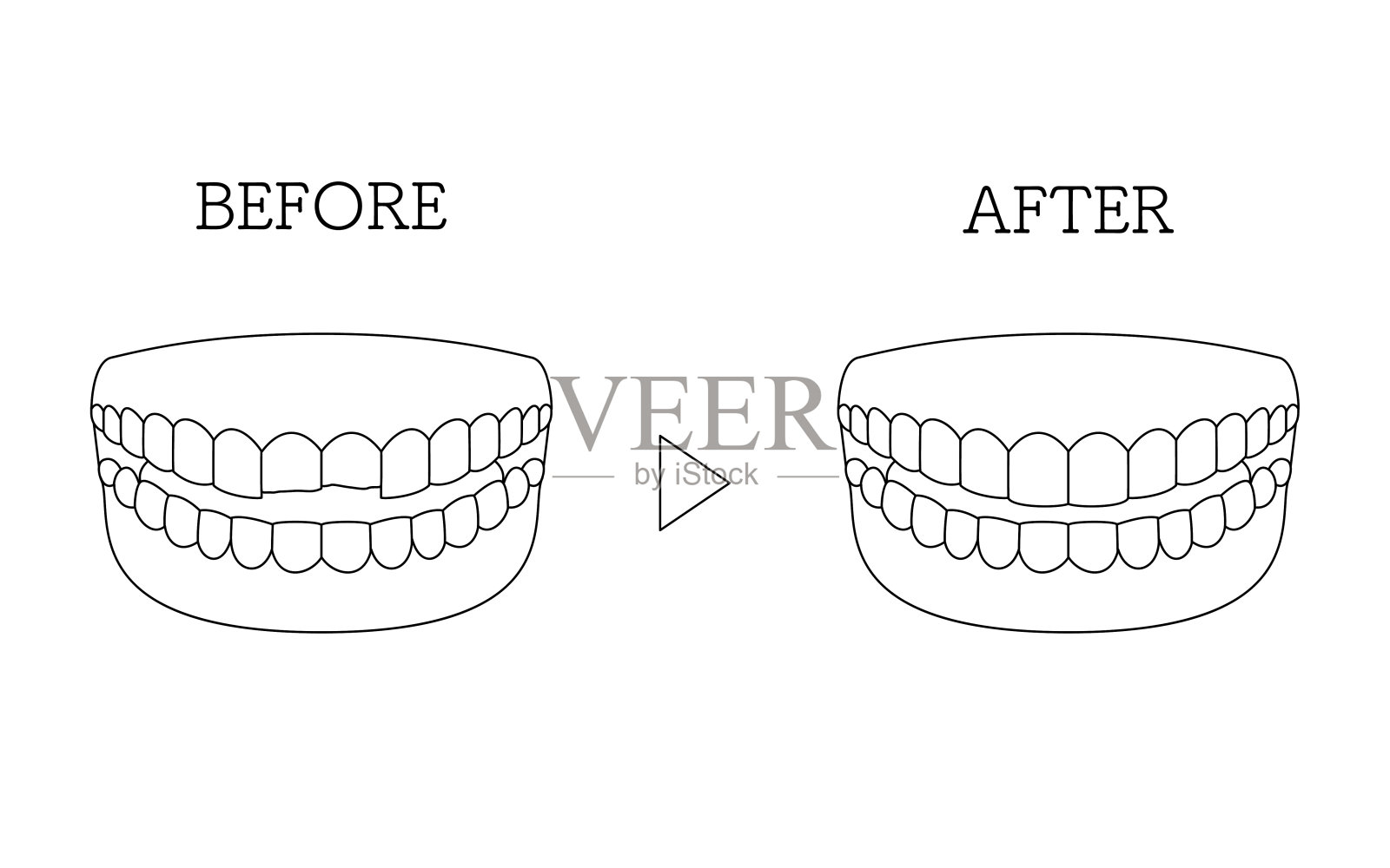 牙科美容，直接粘接前后，碎牙插画图片素材
