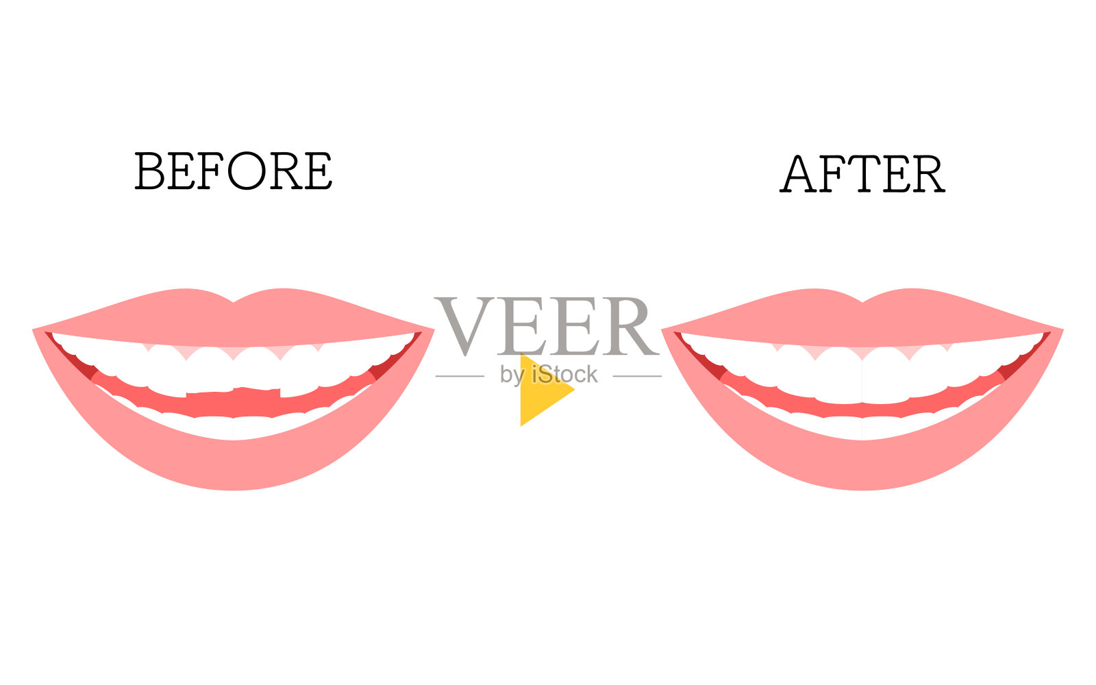 牙科美容，直接粘接前后，碎牙插画图片素材