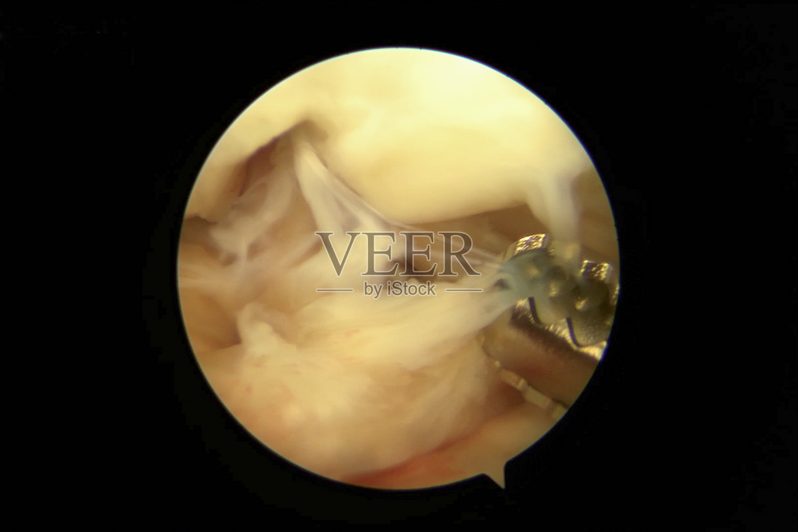 关节镜下切除完整前交叉韧带前的独眼病变照片摄影图片