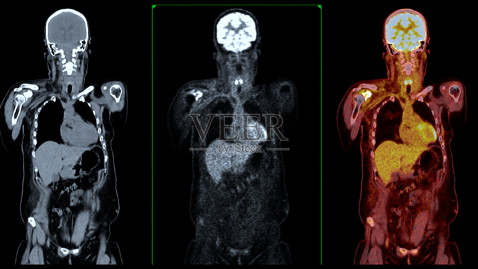 PET CT扫描融合图像通过融合提供详细的图像照片摄影图片