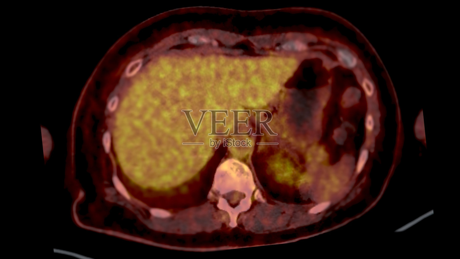 PET CT扫描融合图像通过融合提供详细的图像照片摄影图片