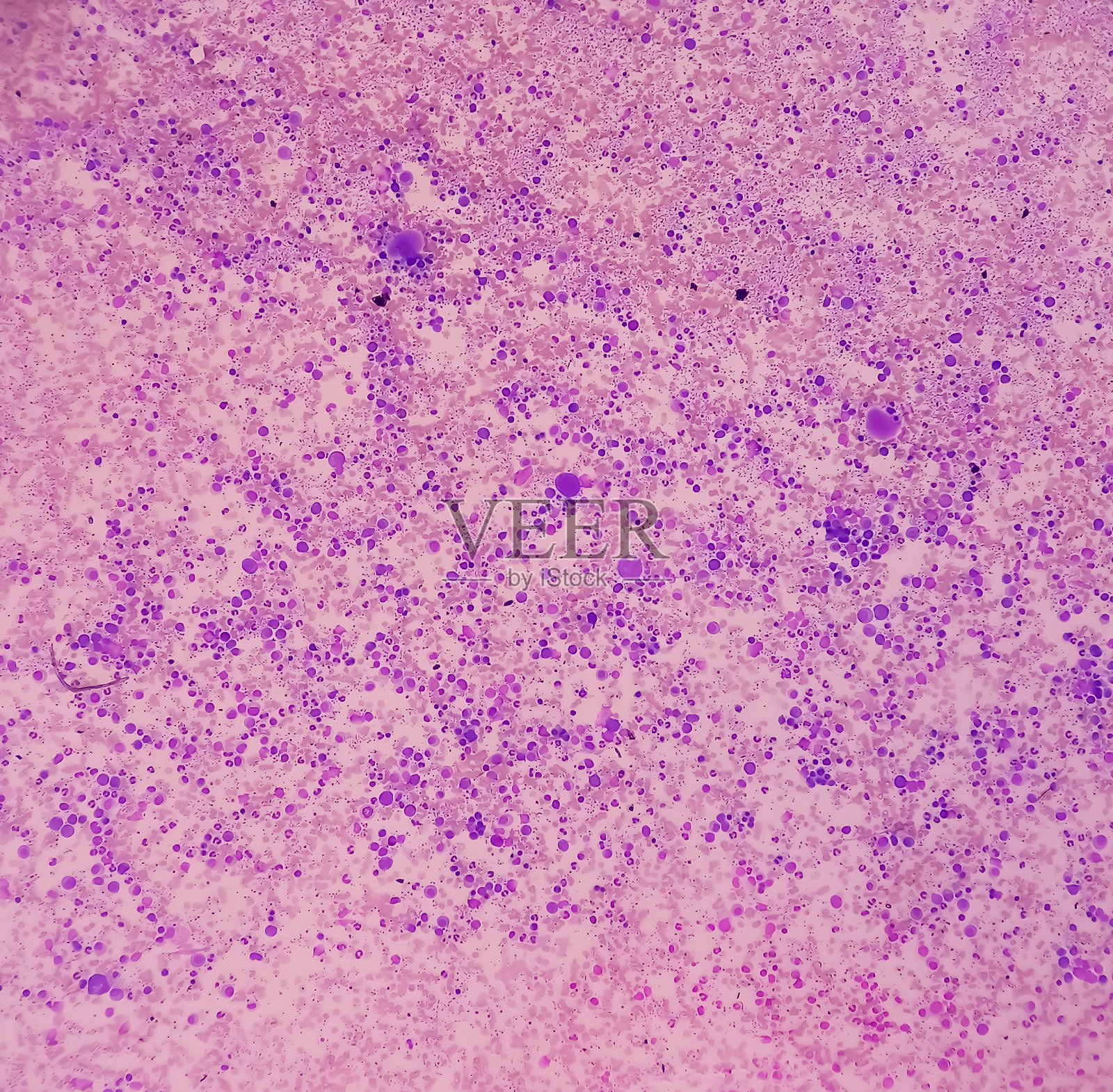 骨髓研究。Panmyelosis。骨髓增生障碍。血小板增多和嗜中性粒细胞增多。照片摄影图片