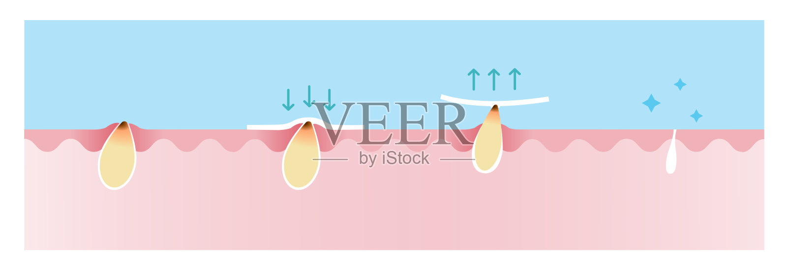步骤的黑头去除矢量插图上的蓝天背景。插画图片素材