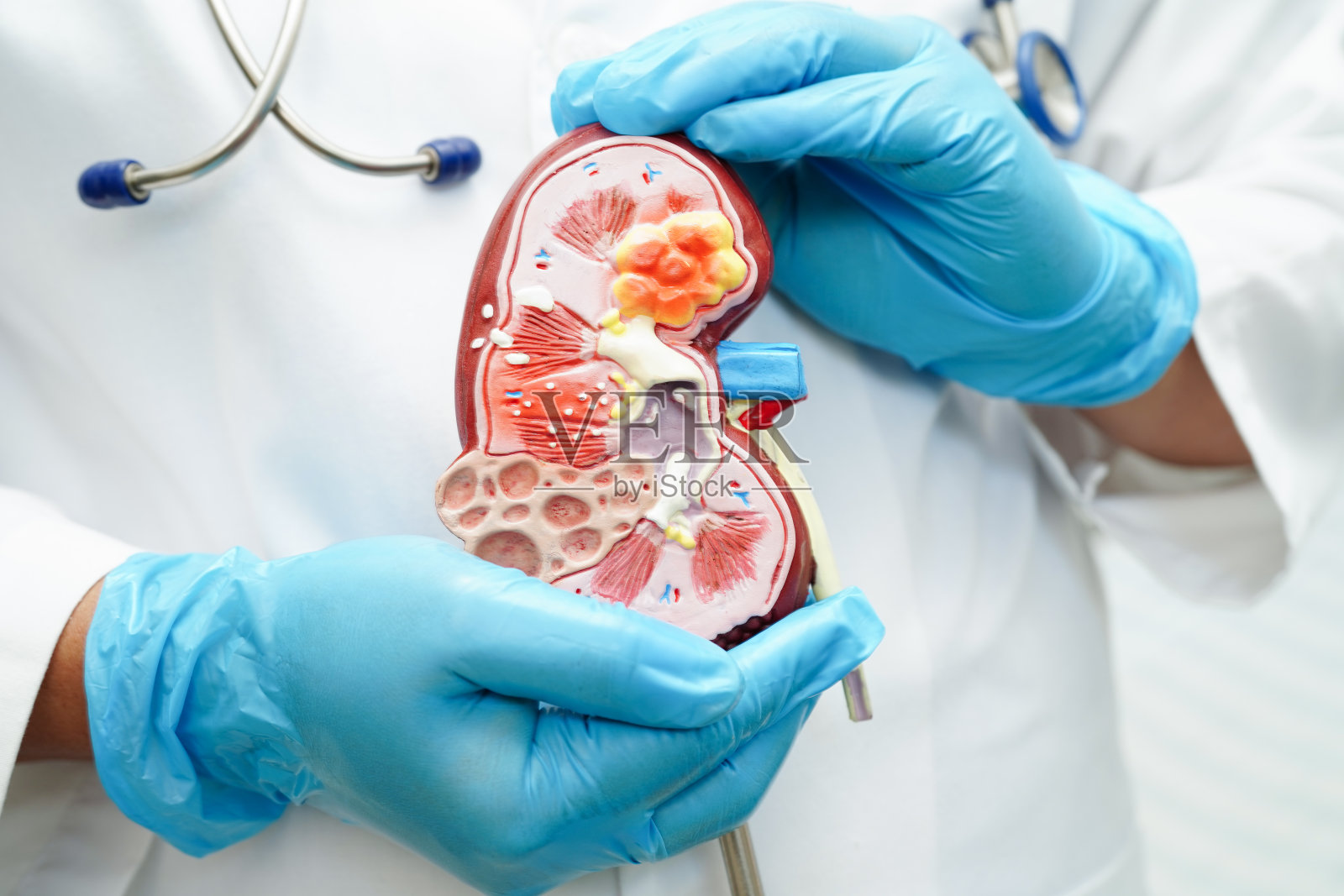 慢性肾脏疾病，医生与模型治疗泌尿系统，泌尿外科，估计肾小球滤过率eGFR。照片摄影图片