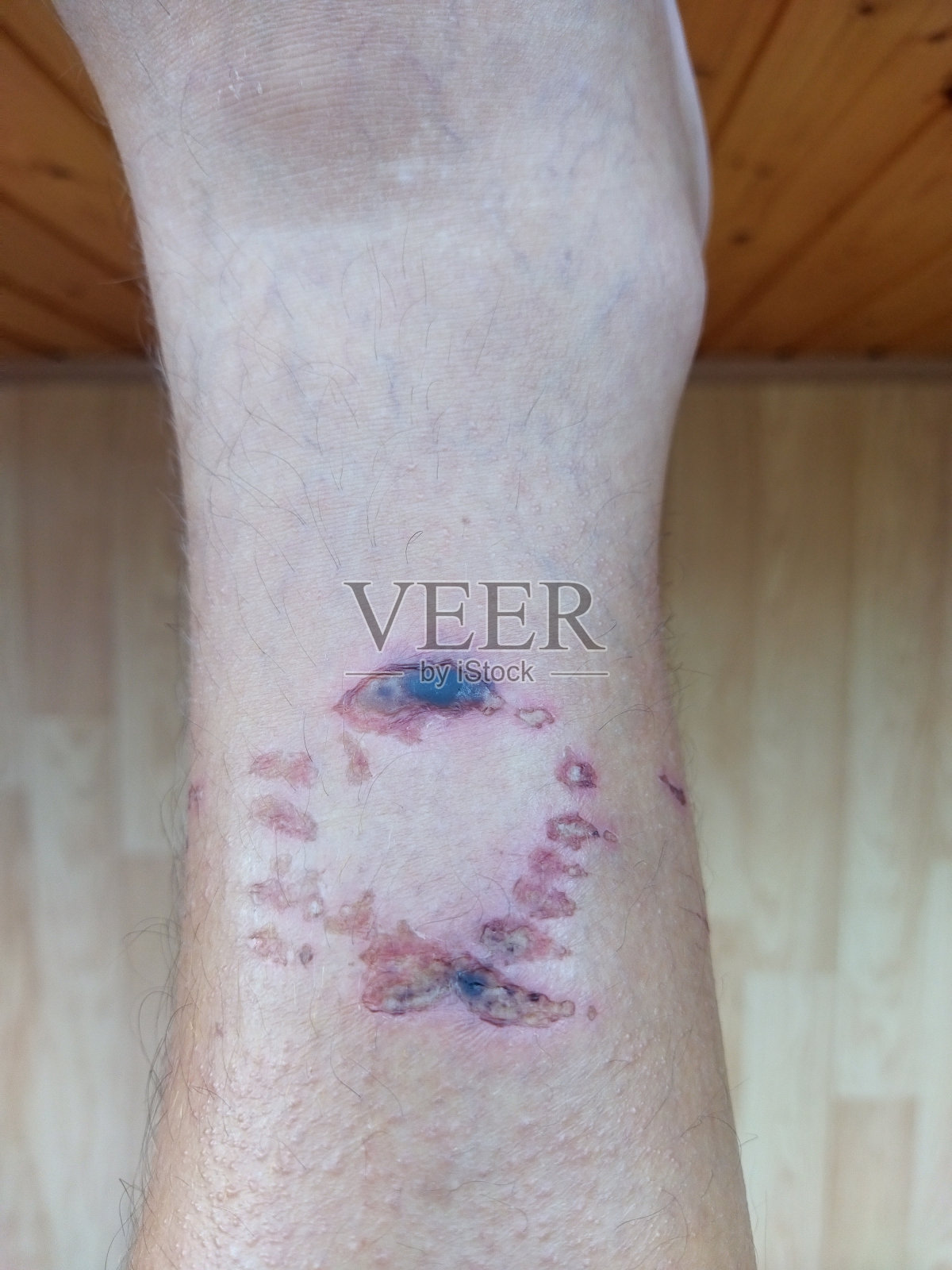 人的腿后被狗咬了一口照片摄影图片