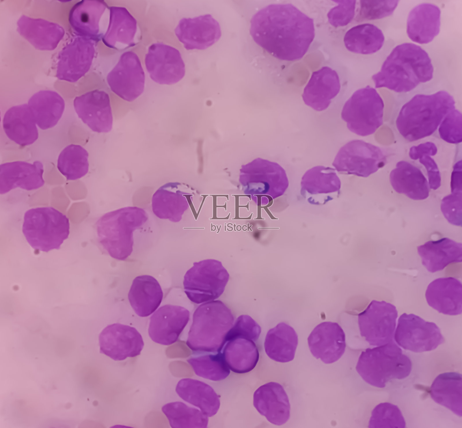 急性髓性白血病(AML)。涂片示胚细胞移位成熟，N: C比低，胞质丰富，染色质疏松，核仁突出。血小板减少症。照片摄影图片