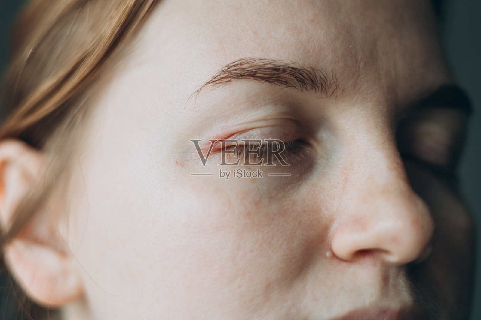 浮肿人眼皮上的浮肿眼睛感染。特应性皮炎症状的皮肤细节纹理。皮肤病学的概念照片摄影图片