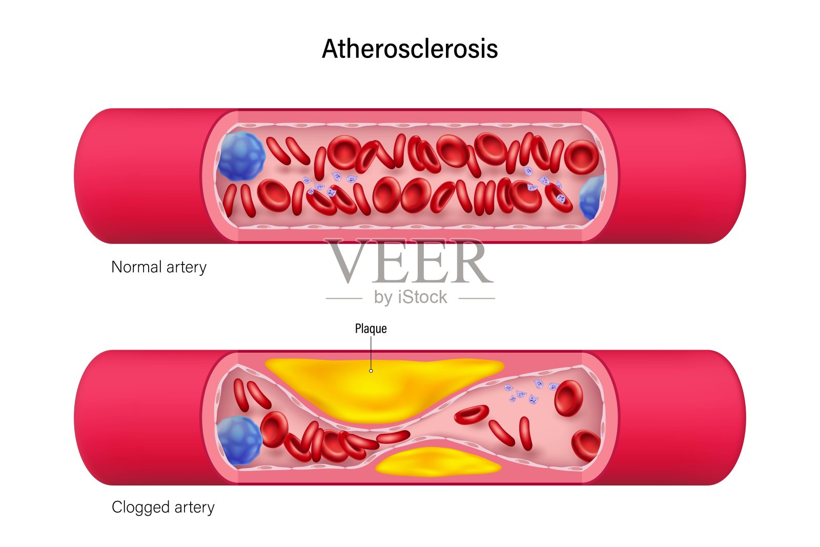 正常动脉和阻塞动脉矢量。心血管病。冠状动脉综合征。血管中的胆固醇。插画图片素材