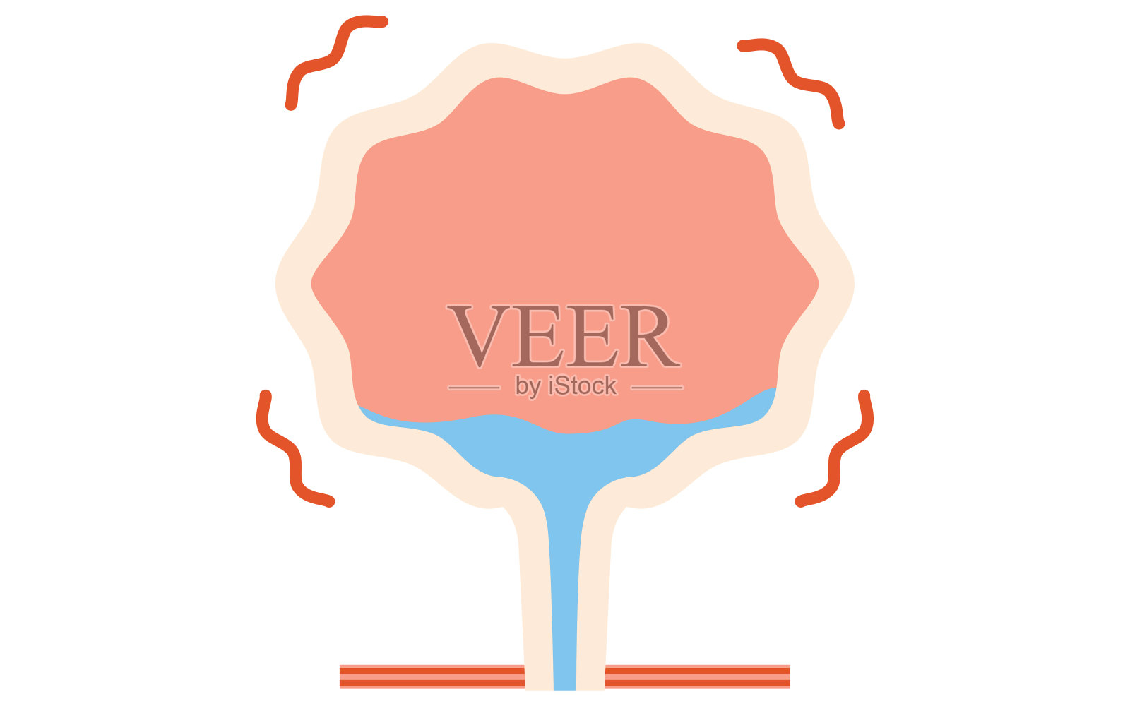 膀胱过度活动的医学例证，即膀胱内无尿时膀胱仍在收缩插画图片素材