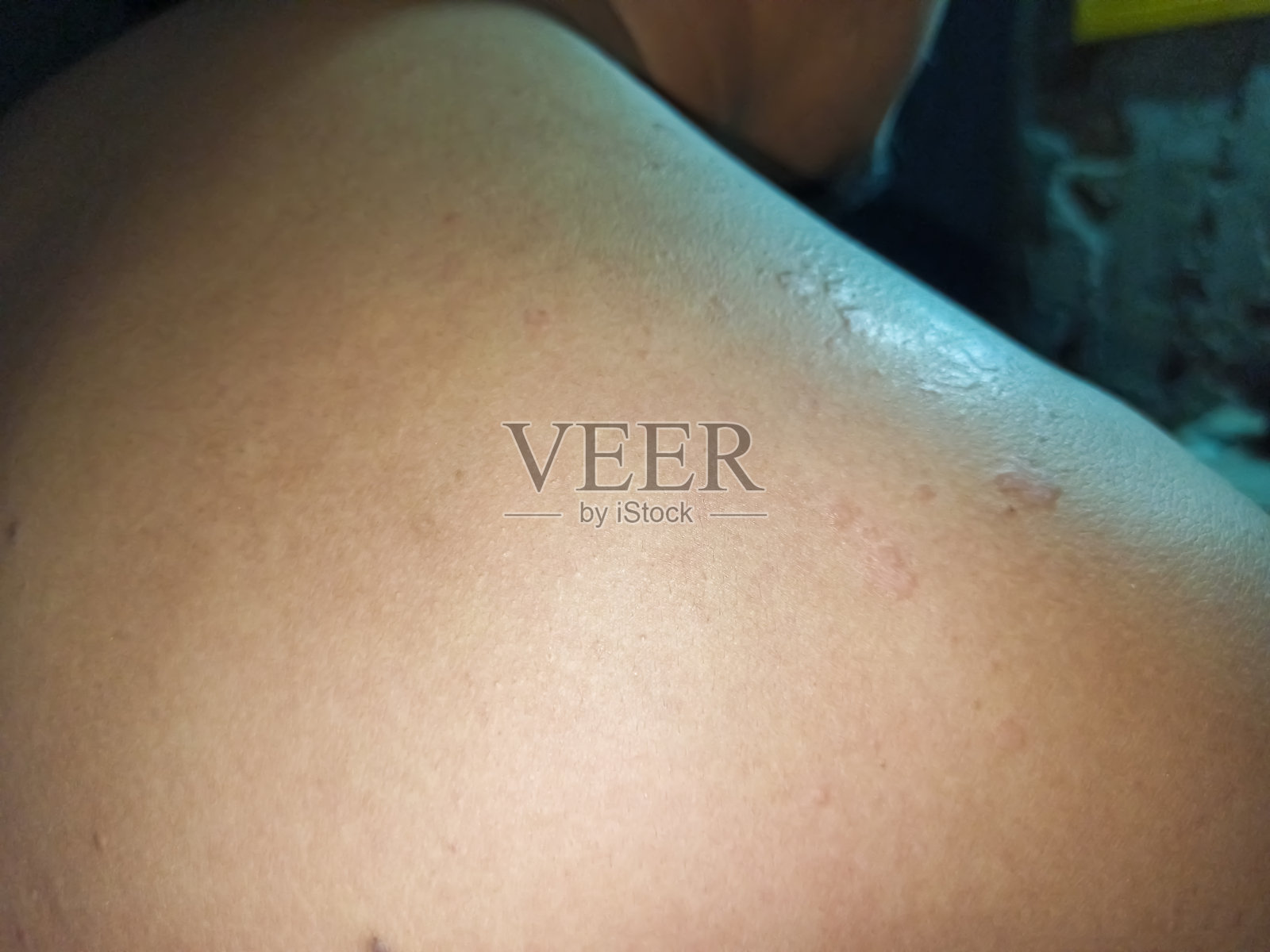 一名男子露出受皮肤病影响的背部。照片摄影图片