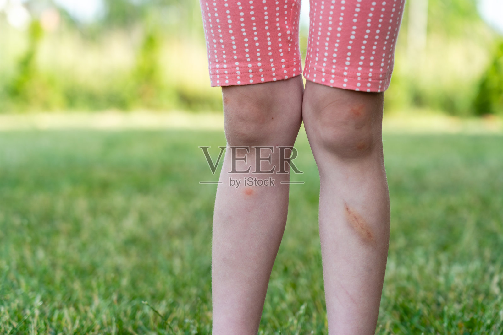 腿上有淤青的小孩。儿童瘀伤照片摄影图片