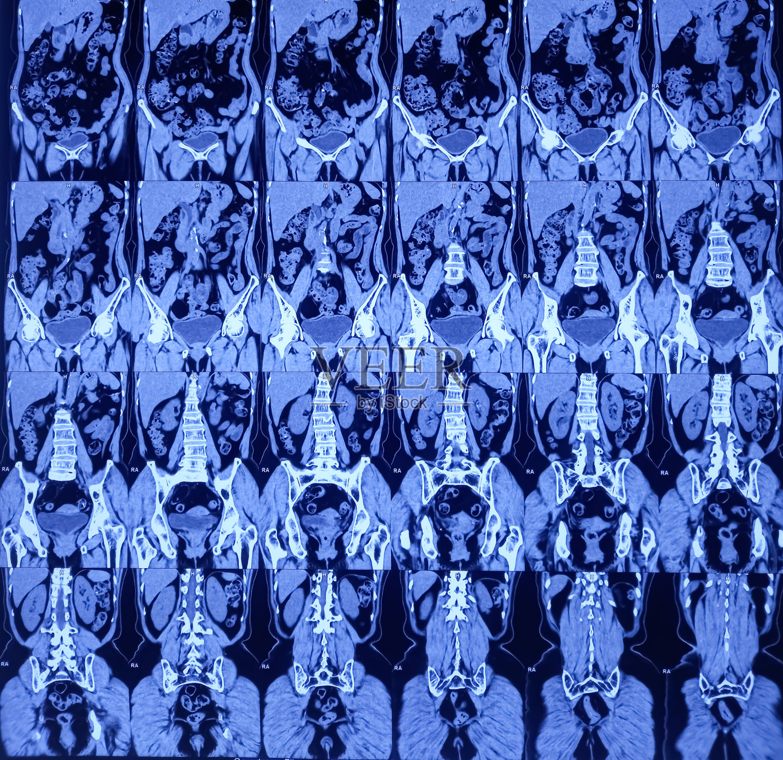 KUB CT扫描(未造影剂):左肾微小结石(无梗阻性特征)。肾结石。照片摄影图片