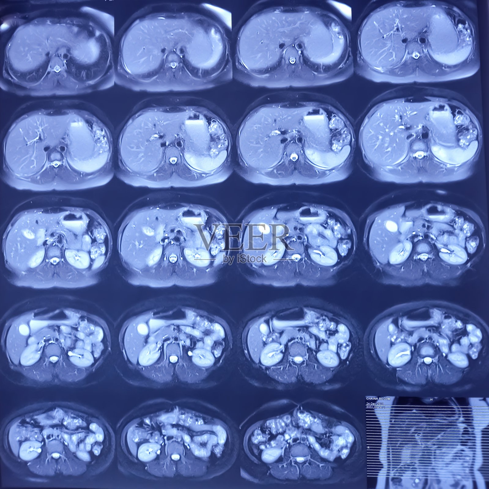 腹部MRI的MRCP片。小颗粒结石，肝结石。用于肝脏、胆管、胰管的医学健康诊断。照片摄影图片